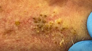 Extreme Blackhead Extraction Summer Throwback  CONTOUR DERMATOLOGY [upl. by Antonella136]