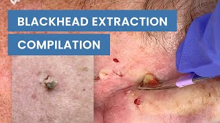 Extraction Satisfaction Blackhead Removal  CONTOUR DERMATOLOGY [upl. by Olocin]