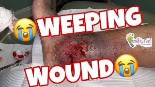 Weeping Wound [upl. by Vins835]