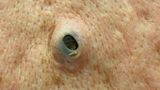 Satisfying Dilated Pore of Winer DPOW Extraction Compilation [upl. by Scrivings306]