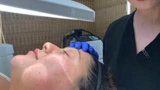 Extractions  Facial Treatment  West Hollywood CA  Dr Jason Emer [upl. by Cymbre]