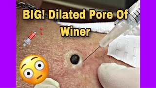 Dilated Pore Of Winer ExtractionRemoval 2019 Video [upl. by Leamsi]