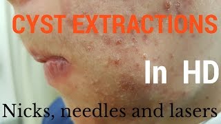 Cysts extractions blackheads  Removal methods in HD [upl. by Nathalie]