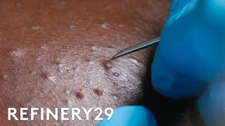 I Got Professional Blackhead Extractions  Macro Beauty  Refinery29 [upl. by Atnwahs673]