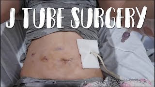 Straight J Tube Jejunostomy Surgery  Feeding Tube For Gastroparesis [upl. by Atterbury]